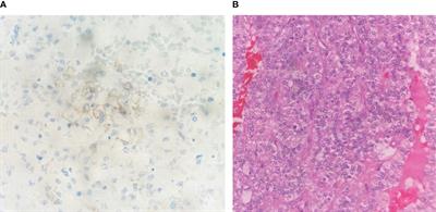 Case report: Ipilimumab and nivolumab in metastatic adrenocortical cancer with high tumor mutational burden